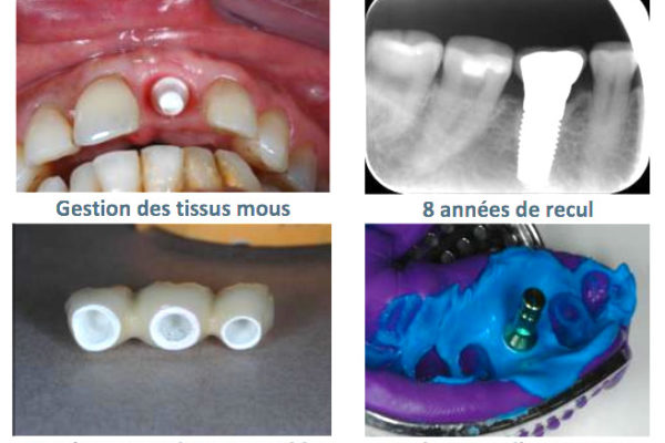Formation Implantologie par Pascal Eppe - ODENTH