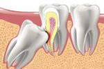 Notre inconscient utilise nos dents de sagesse pour nous parler